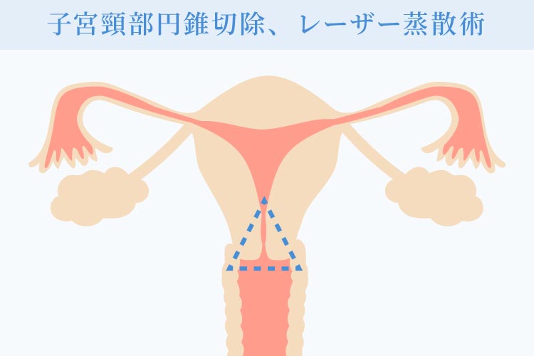子宮頸部円錐切除術について